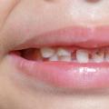 Как правильно лечить кариес молочных зубов у ребенка